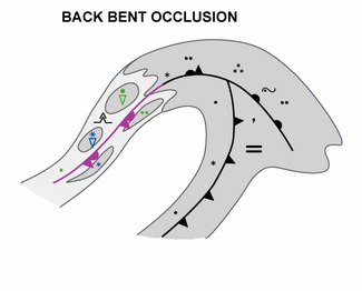 back-bent_occlusion
